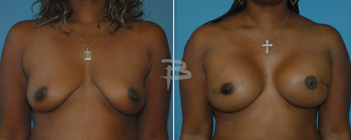 Breast Implant Reconstruction Before & After Gallery - Patient 192277099 - Image 1
