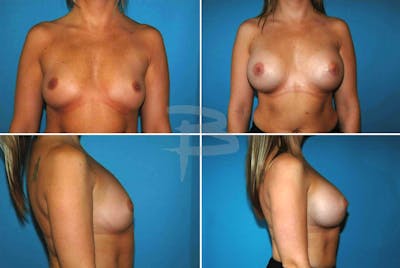 Breast Augmentation Before & After Gallery - Patient 192277101 - Image 1