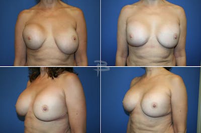 Revisionary Breast Surgery Before & After Gallery - Patient 192277103 - Image 1