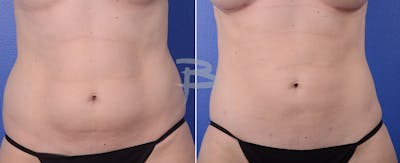 Liposuction Before & After Gallery - Patient 192277104 - Image 1