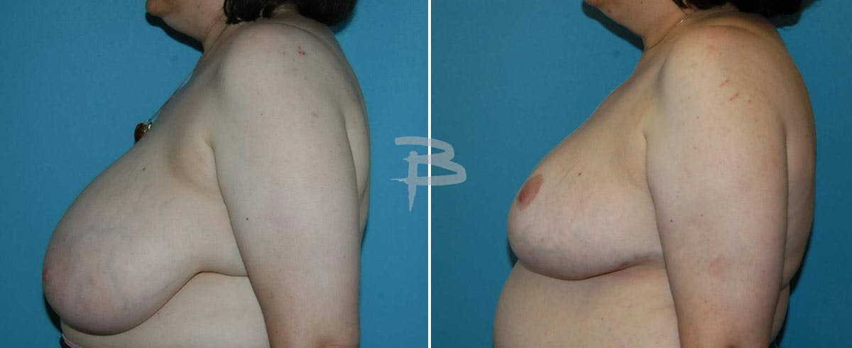 Breast Reduction Before & After Gallery - Patient 192277102 - Image 1