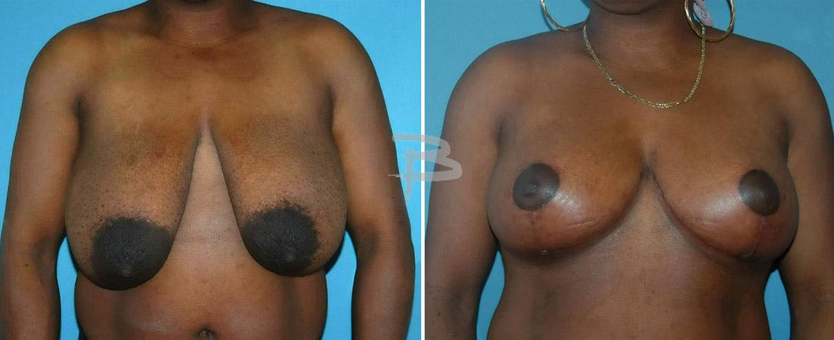 Breast Lift Before & After Gallery - Patient 192277100 - Image 1