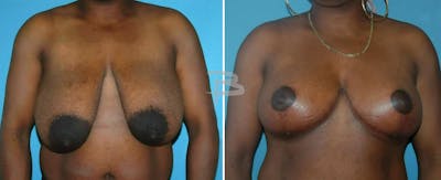 Breast Lift Before & After Gallery - Patient 192277100 - Image 1