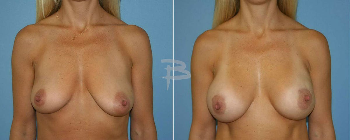 Breast Implant Reconstruction Before & After Gallery - Patient 192277105 - Image 1