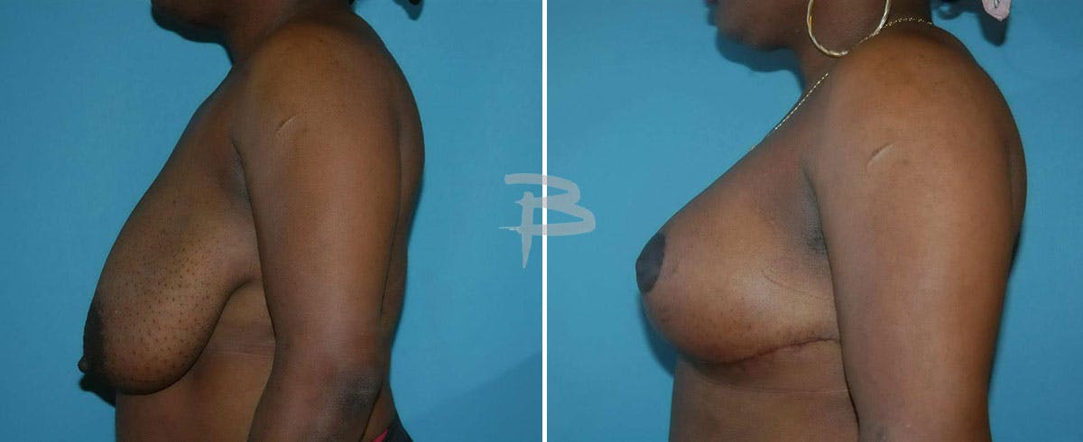 Breast Lift Before & After Gallery - Patient 192277106 - Image 1