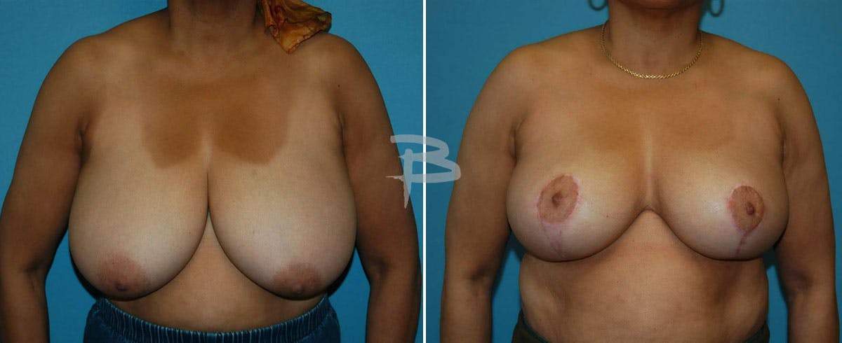 Breast Reduction Before & After Gallery - Patient 192277108 - Image 1