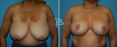 Breast Reduction Before & After Gallery - Patient 192277108 - Image 1