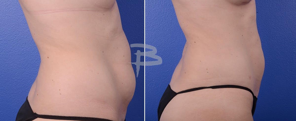 Liposuction Before & After Gallery - Patient 192277107 - Image 1