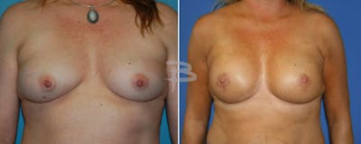 Breast Implant Reconstruction Before & After Gallery - Patient 192277111 - Image 1
