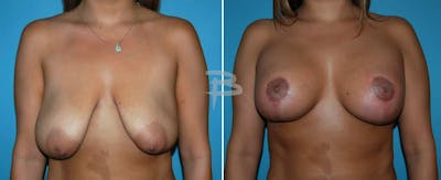 Breast Lift Before & After Gallery - Patient 192277112 - Image 1