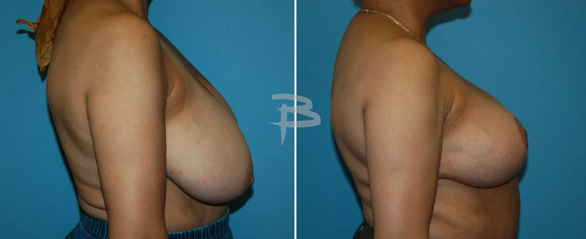 Breast Reduction Before & After Gallery - Patient 192277113 - Image 1