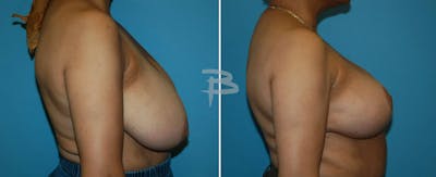 Breast Reduction Before & After Gallery - Patient 192277113 - Image 1