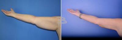 Liposuction Before & After Gallery - Patient 192277114 - Image 1