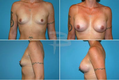 Breast Augmentation Before & After Gallery - Patient 192277116 - Image 1