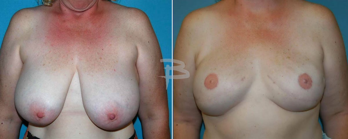 Breast Implant Reconstruction Before & After Gallery - Patient 192277115 - Image 1