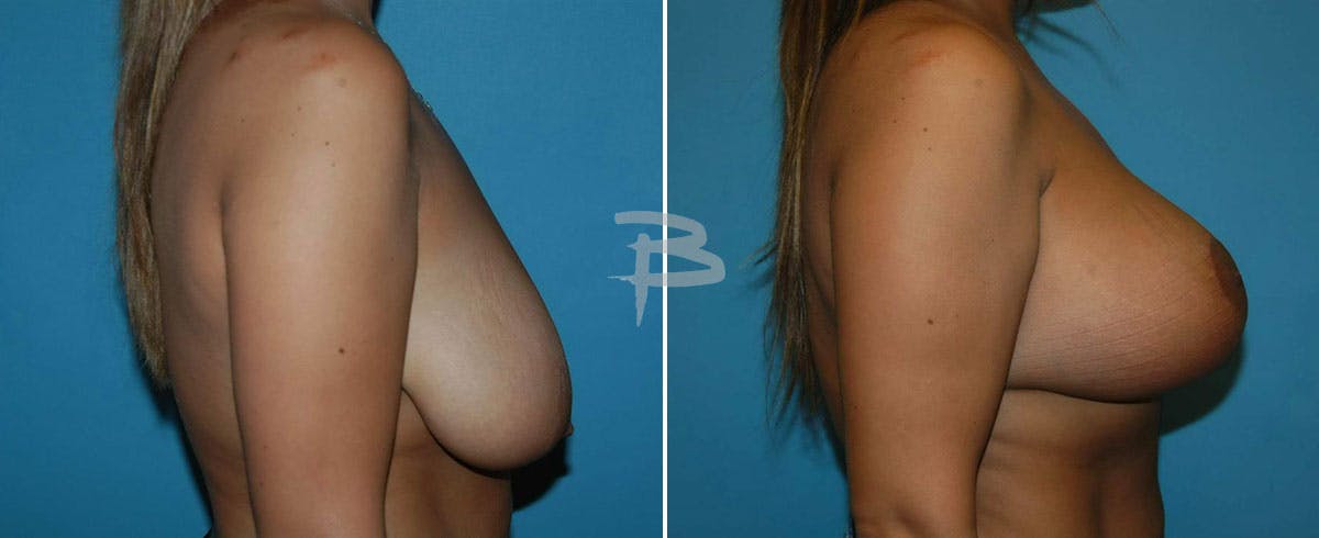 Breast Lift Before & After Gallery - Patient 192277118 - Image 1
