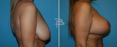 Breast Lift Before & After Gallery - Patient 192277118 - Image 1