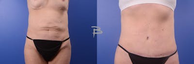Abdominoplasty Before & After Gallery - Patient 192277121 - Image 1