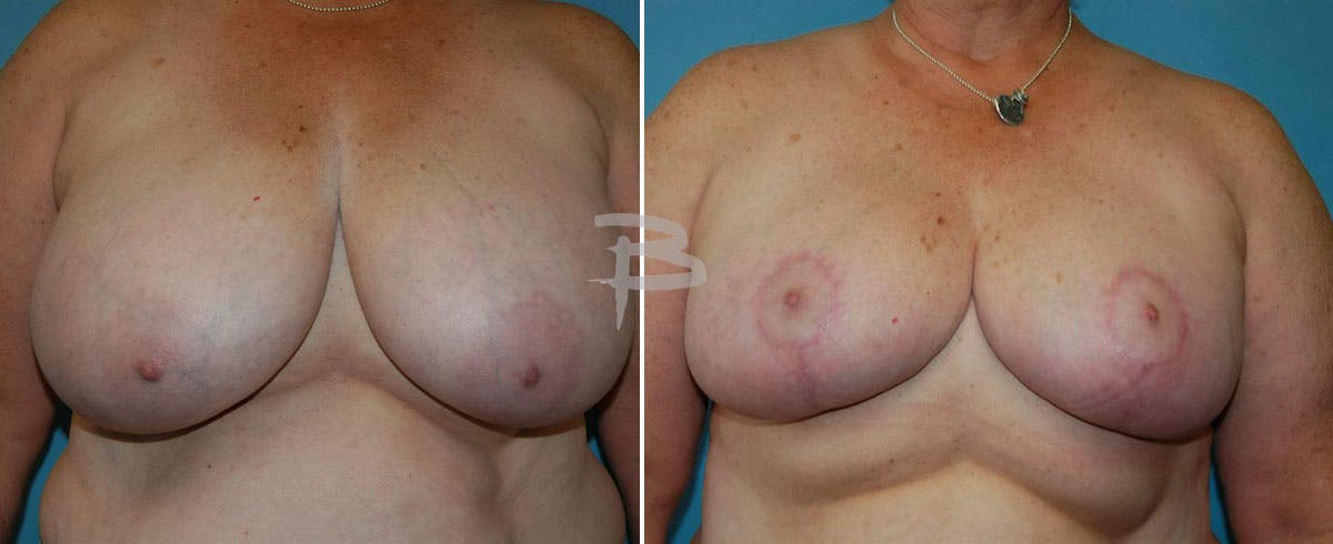 Breast Reduction Before & After Gallery - Patient 192277119 - Image 1