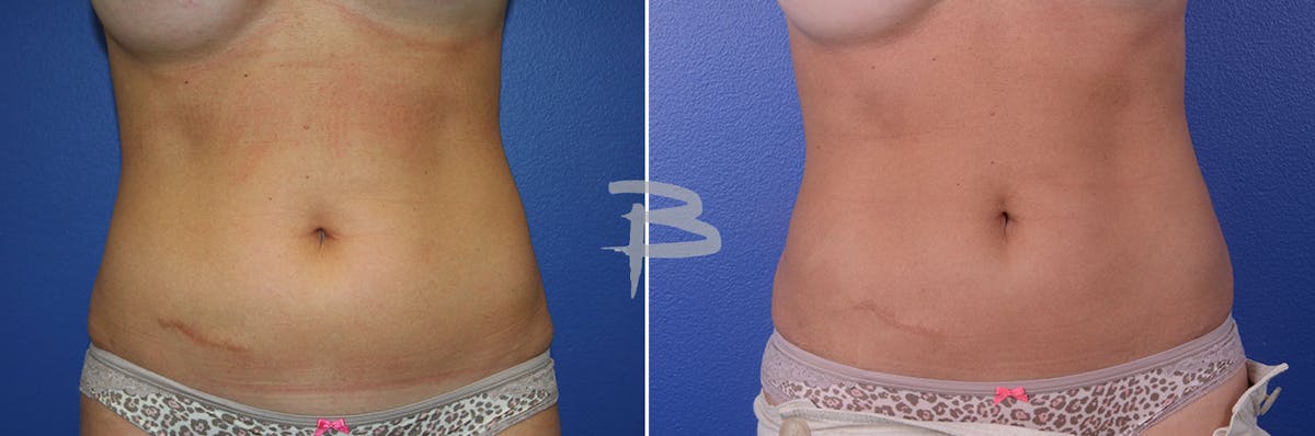 Liposuction Before & After Gallery - Patient 192277120 - Image 1