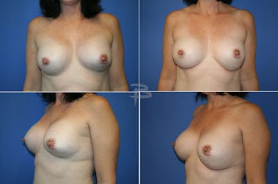 Revisionary Breast Surgery Before & After Gallery - Patient 192277133 - Image 1