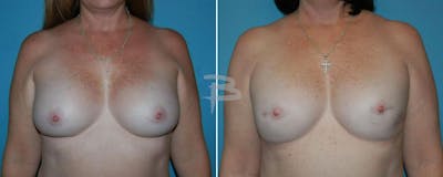 Breast Implant Reconstruction Before & After Gallery - Patient 192277122 - Image 1