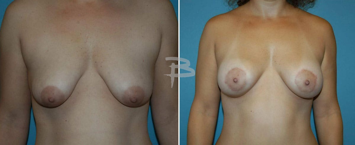 Breast Lift Before & After Gallery - Patient 192277123 - Image 1