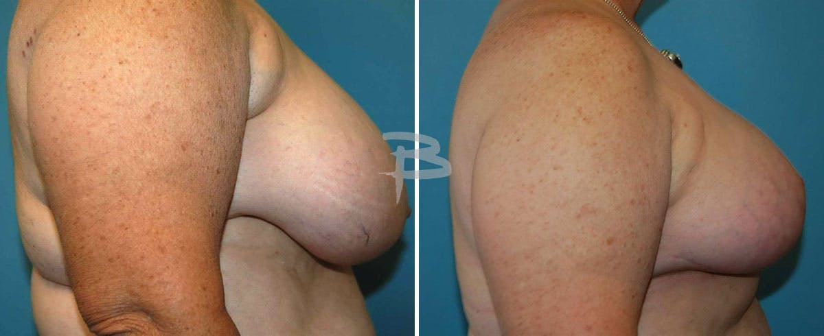 Breast Reduction Before & After Gallery - Patient 192277132 - Image 1