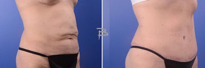 Abdominoplasty Before & After Gallery - Patient 192277134 - Image 1