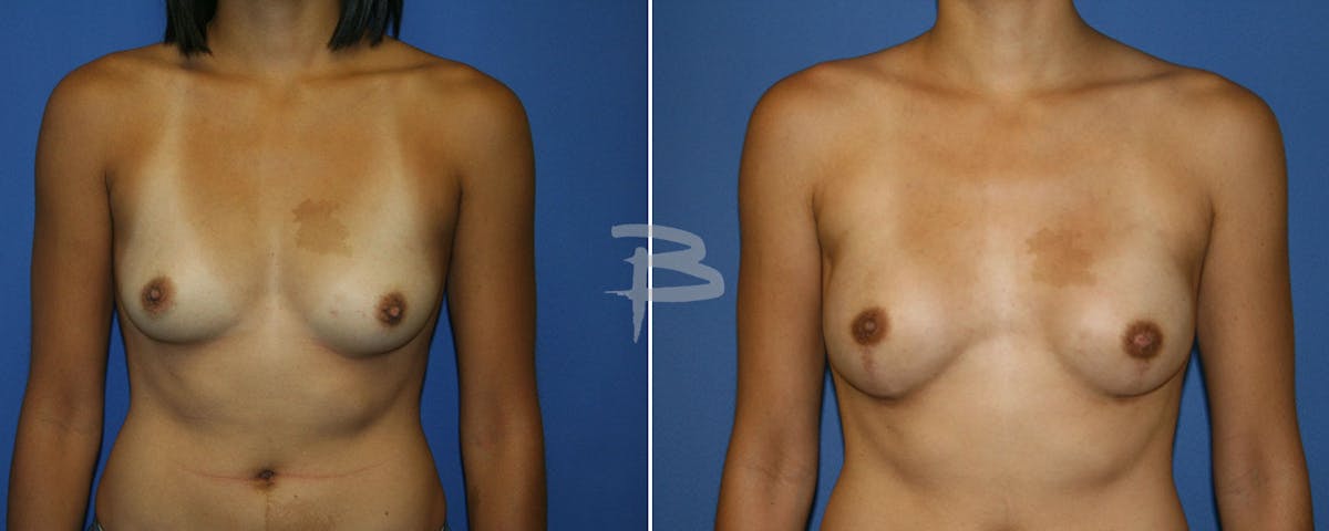 Breast Implant Reconstruction Before & After Gallery - Patient 192277141 - Image 1