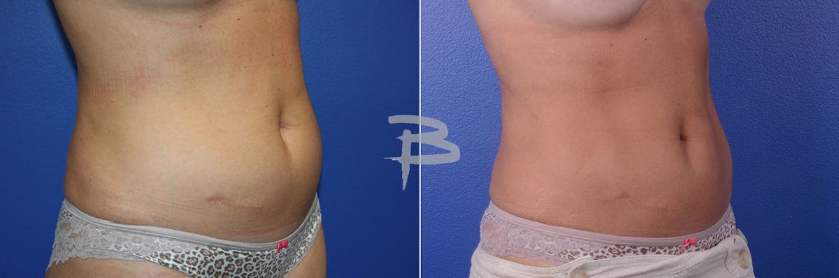Liposuction Before & After Gallery - Patient 192277145 - Image 1
