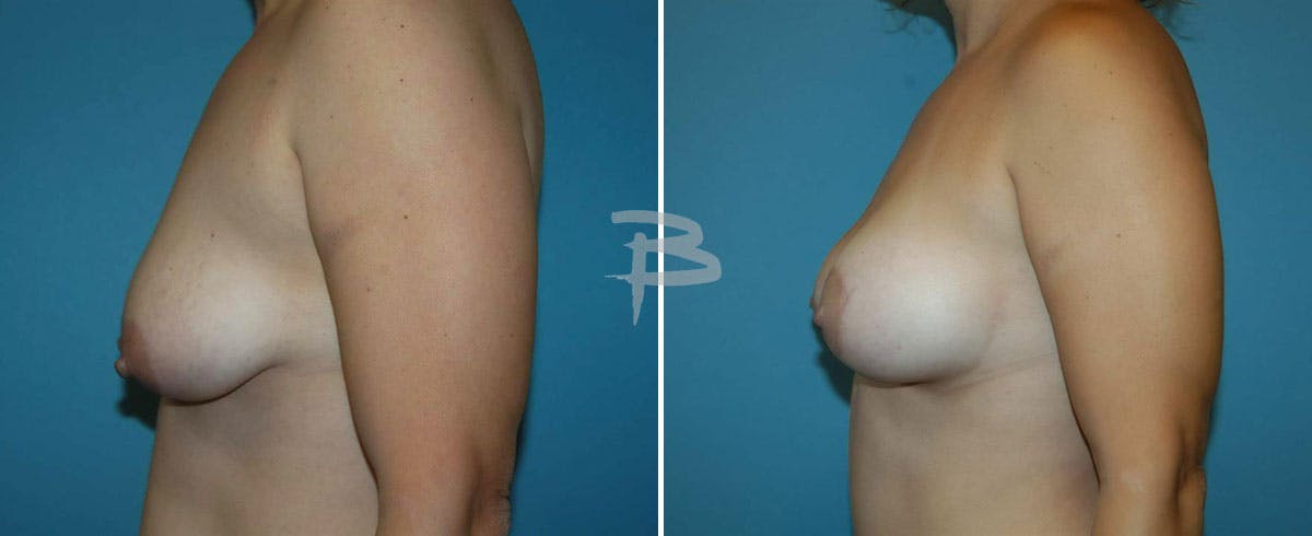 Breast Lift Before & After Gallery - Patient 192277140 - Image 1