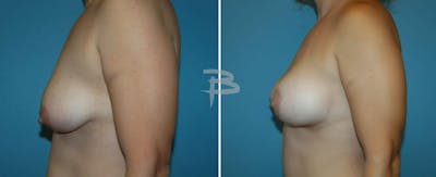 Breast Lift Before & After Gallery - Patient 192277140 - Image 1