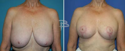 Breast Reduction Before & After Gallery - Patient 192277142 - Image 1