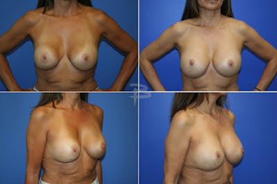 Revisionary Breast Surgery Before & After Gallery - Patient 192277146 - Image 1