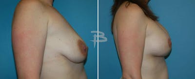 Breast Lift Before & After Gallery - Patient 192277154 - Image 1