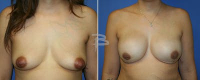 Breast Implant Reconstruction Before & After Gallery - Patient 192277153 - Image 1