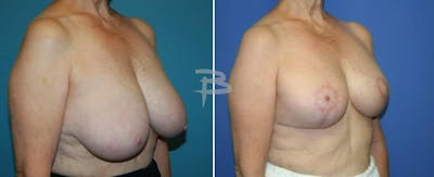Breast Reduction Before & After Gallery - Patient 192277150 - Image 1