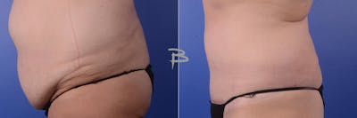 Abdominoplasty Before & After Gallery - Patient 192277156 - Image 1