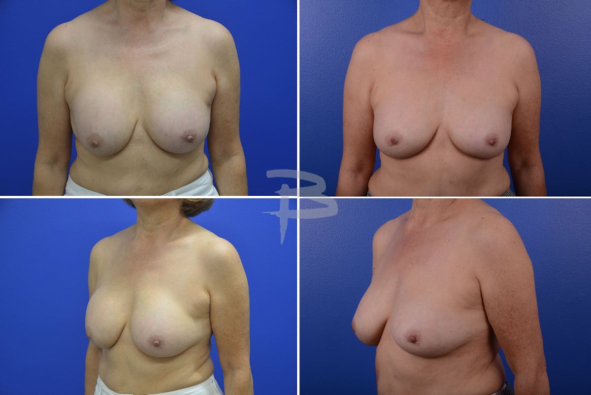 Revisionary Breast Surgery Before & After Gallery - Patient 192277159 - Image 1