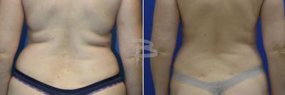 Liposuction Before & After Gallery - Patient 192277157 - Image 1