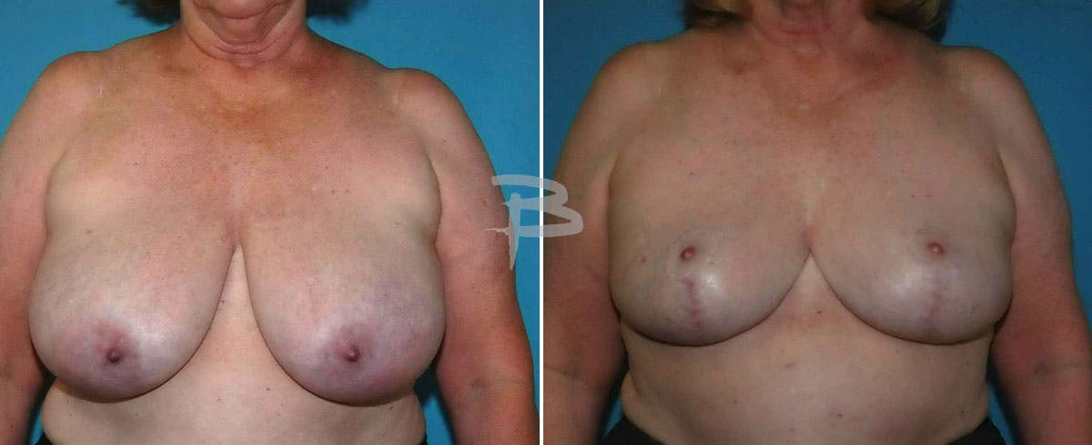 Breast Reduction Before & After Gallery - Patient 192277158 - Image 1