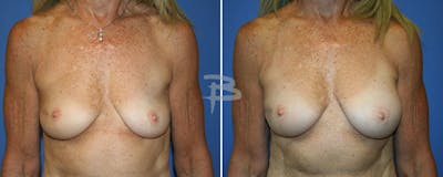 Breast Implant Reconstruction Before & After Gallery - Patient 192277160 - Image 1