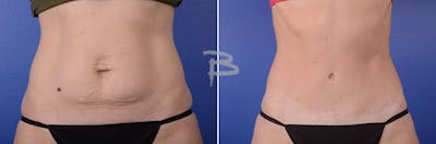 Abdominoplasty Before & After Gallery - Patient 192277162 - Image 1