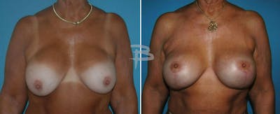 Breast Lift Before & After Gallery - Patient 192277163 - Image 1