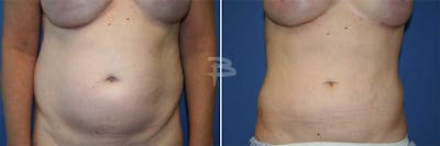 Liposuction Before & After Gallery - Patient 192277165 - Image 1