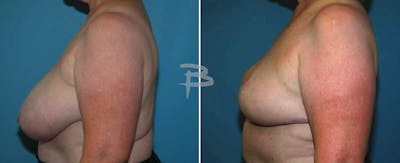 Breast Reduction Before & After Gallery - Patient 192277166 - Image 1