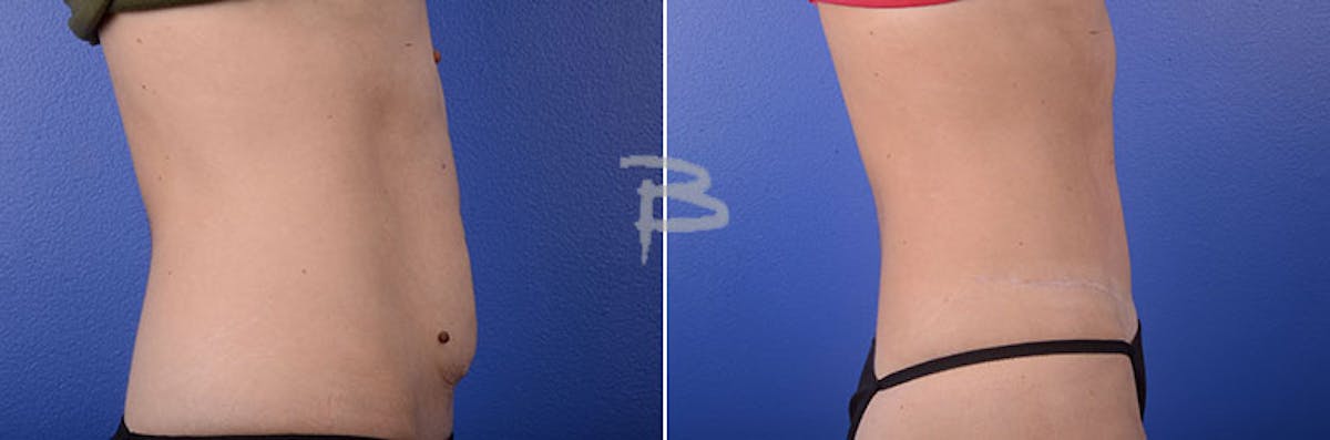 Abdominoplasty Before & After Gallery - Patient 192277192 - Image 1