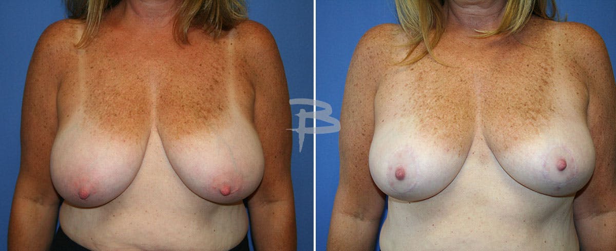 Breast Reduction Before & After Gallery - Patient 192277220 - Image 1