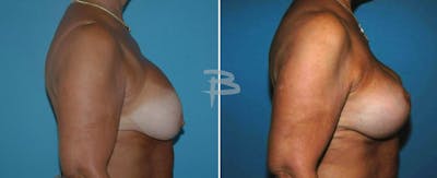 Breast Lift Before & After Gallery - Patient 192277212 - Image 1
